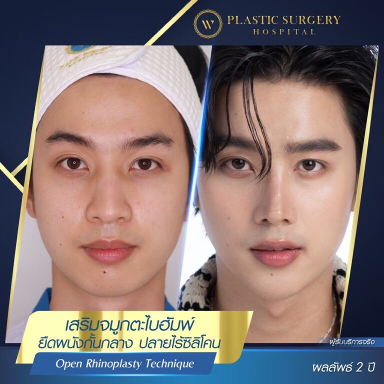 LINE_ALBUM_ศัลยกรรมเสริมจมูก_260624_1