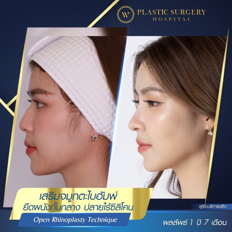 LINE_ALBUM_ศัลยกรรมเสริมจมูก_260624_10