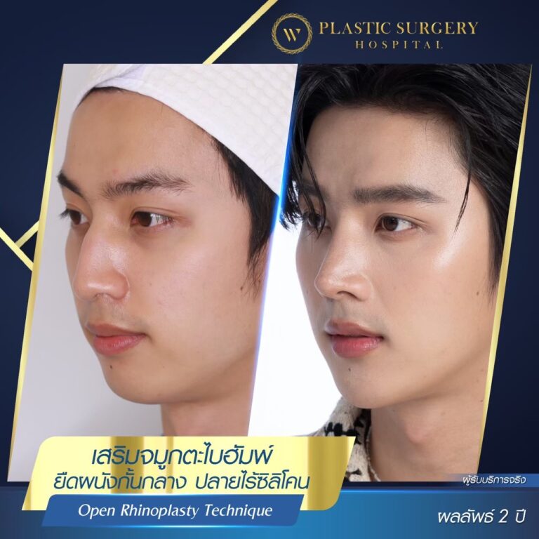 LINE_ALBUM_ศัลยกรรมเสริมจมูก_260624_2
