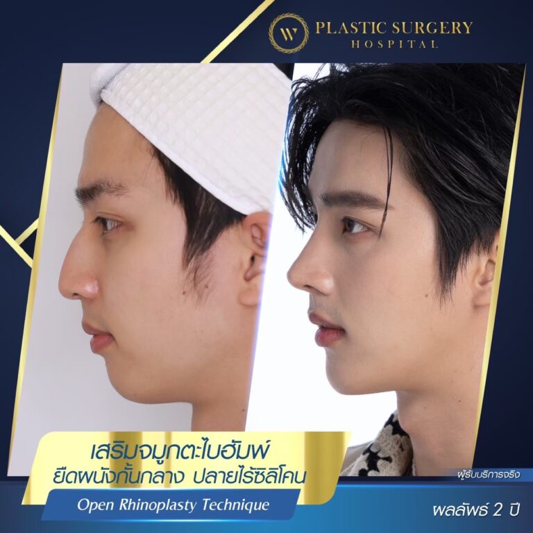 LINE_ALBUM_ศัลยกรรมเสริมจมูก_260624_3